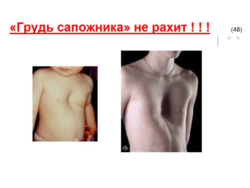 «Грудь сапожника» не рахит ! ! !      (48)